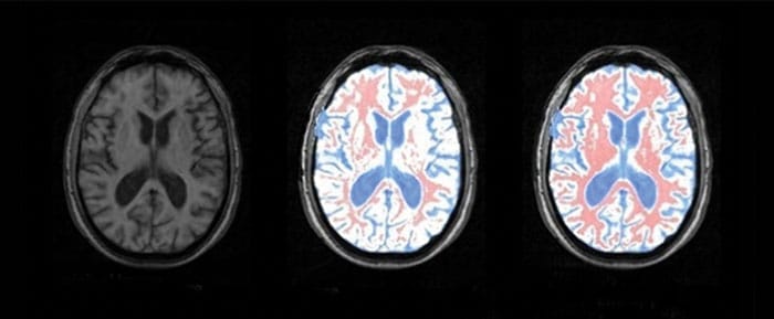 MRI scans of the brain revealing how Tsallis entropy can help us to pinpoint different kinds of tissue