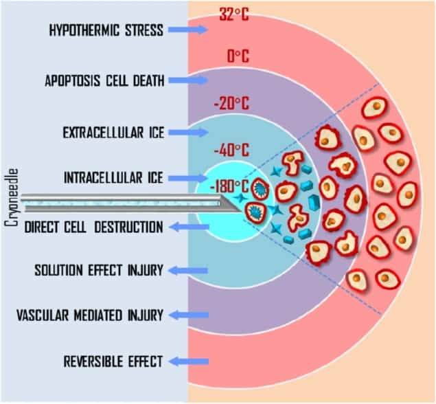 Biological effects of cryotherapy Biological effects of cryotherapy