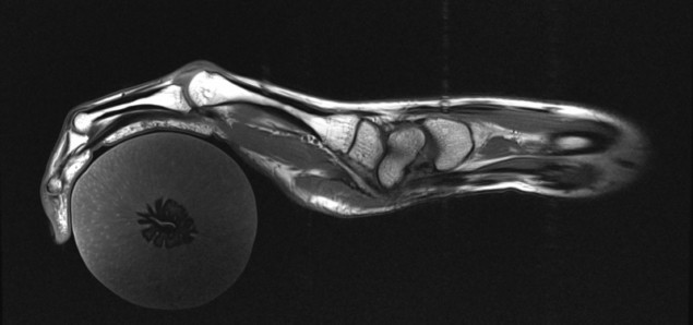 MRI of a hand