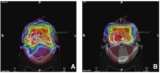 Dose maps