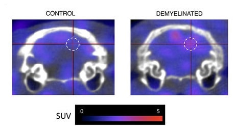 PET detection of demyelination PET detection of demyelination