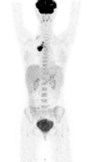 PET/CT scan of a patient with Hodgkin's lymphoma