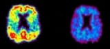 PiB-PET scans