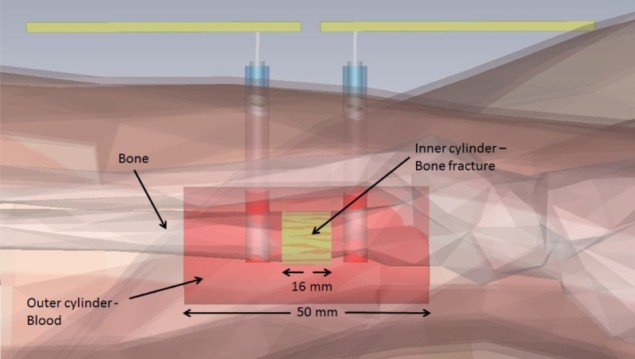 Simulated bone fracture Simulated bone fracture