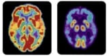 PET scans of normal and Alzheimer's brains