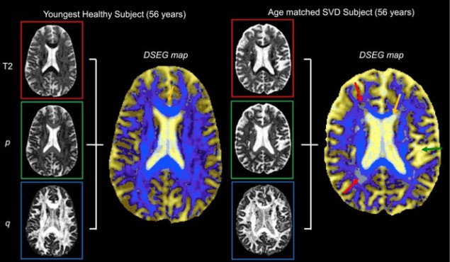 DSEG colour maps from healthy and SVD brains