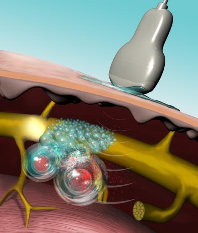 Ultrasound interacts PPIX with to burst the liposome