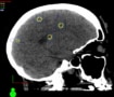 Image showing multiple brain tumours