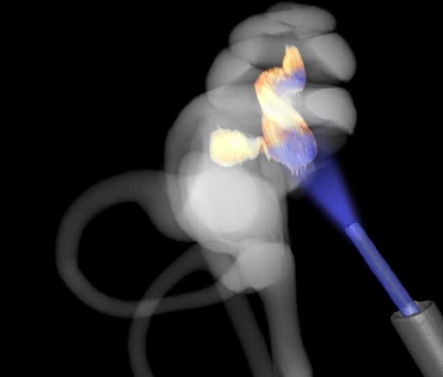 Optogenetic hearing restoration Optogenetic hearing restoration