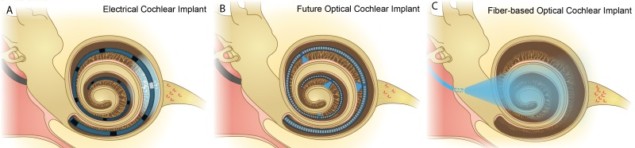 Cochlear implants
