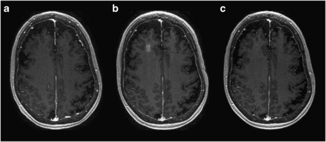 MRI images showing the opening of the blood–brain barrier