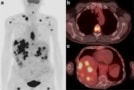 PET/CT restaging