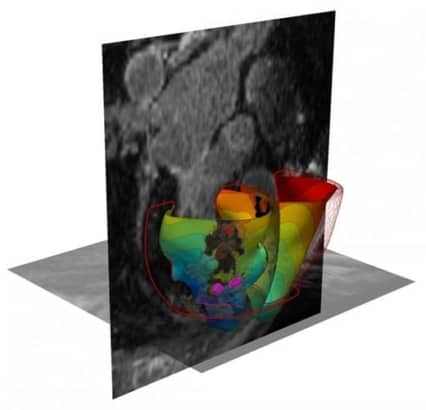 3D virtual heart helps pinpoint irregular heartbeat – Physics World