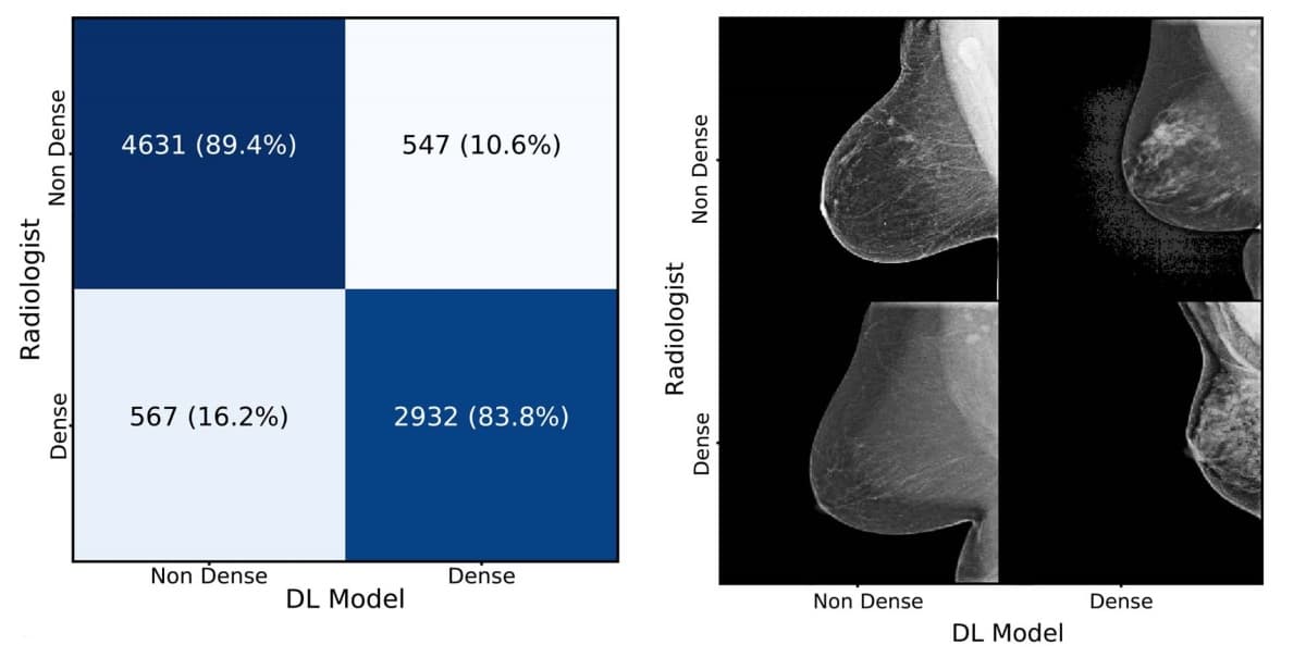 Deep-learning algorithm identifies dense tissue in mammograms