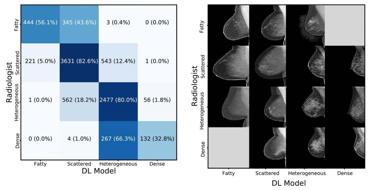 Deep-learning algorithm identifies dense tissue in mammograms