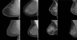 Breast density classification