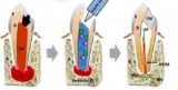 Schematic of the treatment