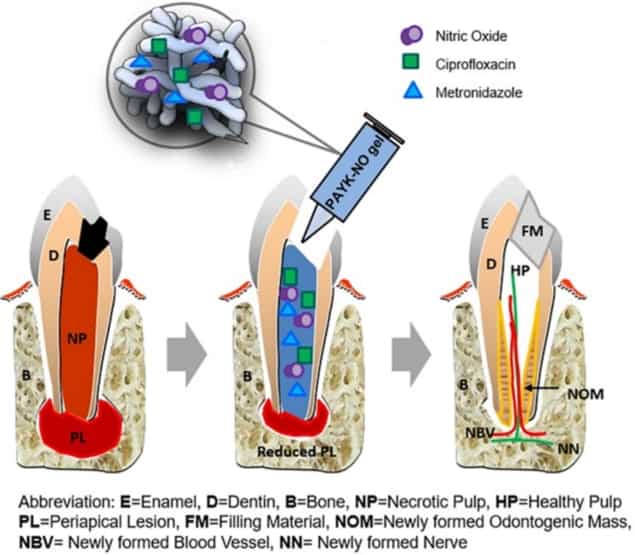 Gel filling enhances root canal treatment – Physics World