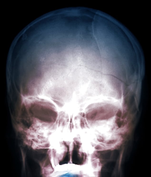 Skull fracture X-ray