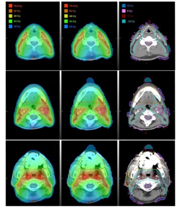 Deep learning enables automatic radiotherapy planning – Physics World