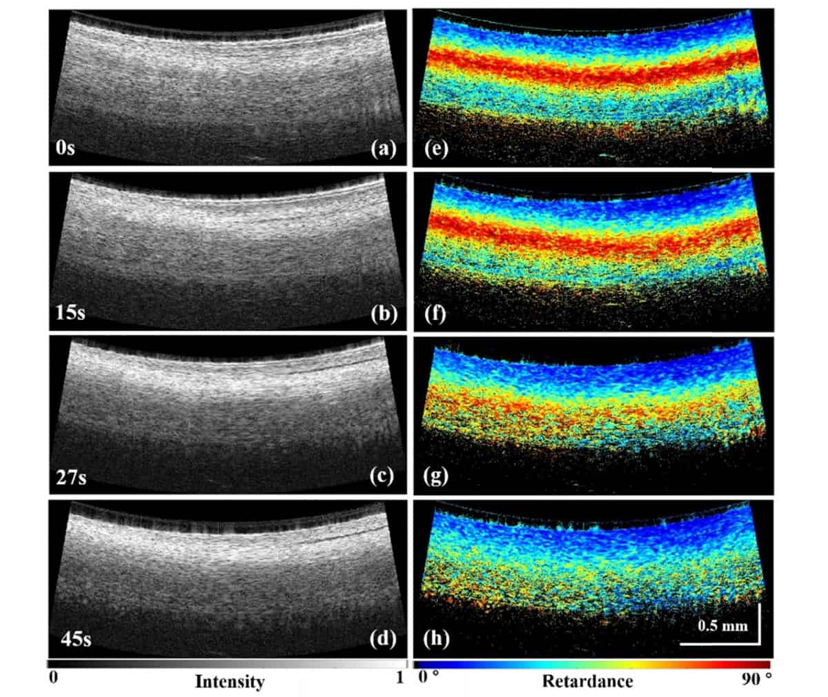 Monitoring lesion formation
