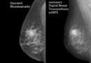 sDBT vs mammogram