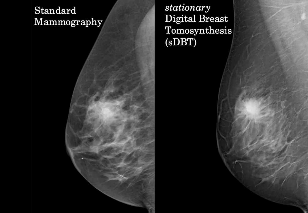 Breast cancer detection: advantage DBT •