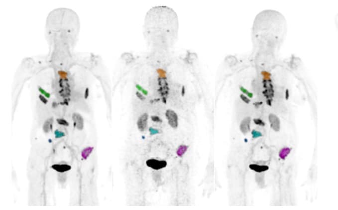 New PET Tracers Show Immense Promise In Cancer Imaging – Physics World