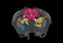 MR elastography