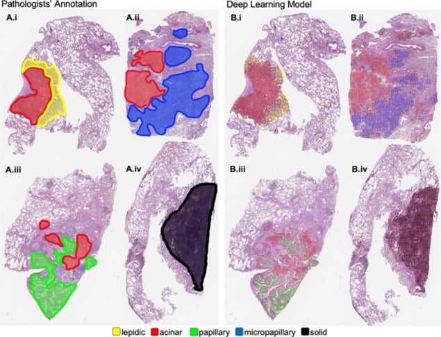 Colour-coded histologic patterns Colour-coded histologic patterns