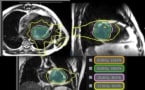 MRI-linac treatment plan