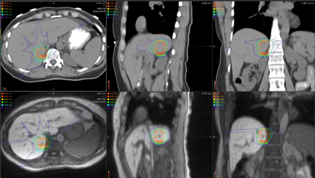MR images of liver metastases