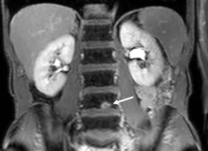 Wholebody MRI gets cancer detection boost Physics World