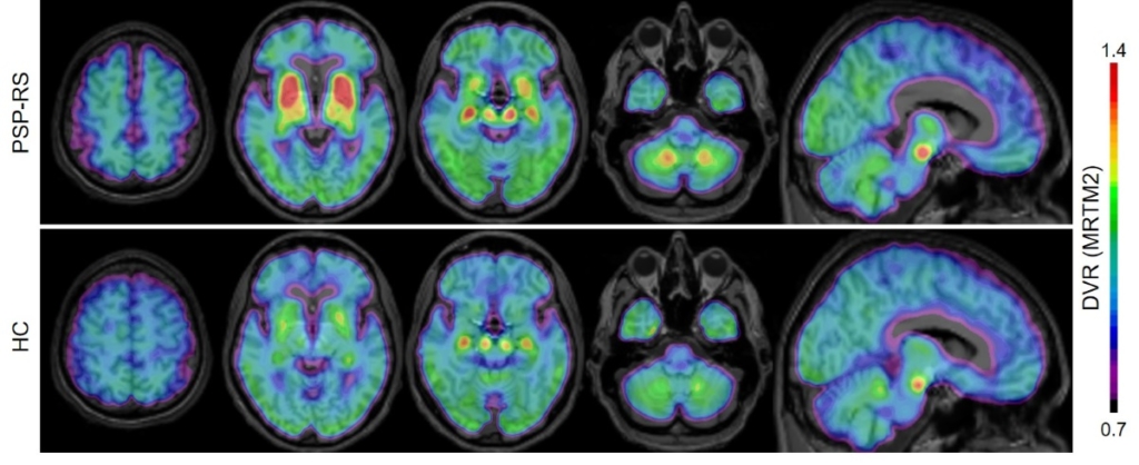 SNMMI Annual Meeting showcases nuclear medicine innovation – Physics World