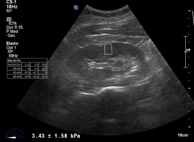 Shear wave elastography Shear wave elastography