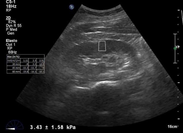 Shear wave elastography