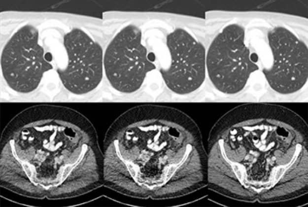 Image: AI converts low-dose CT images to high-quality scans
