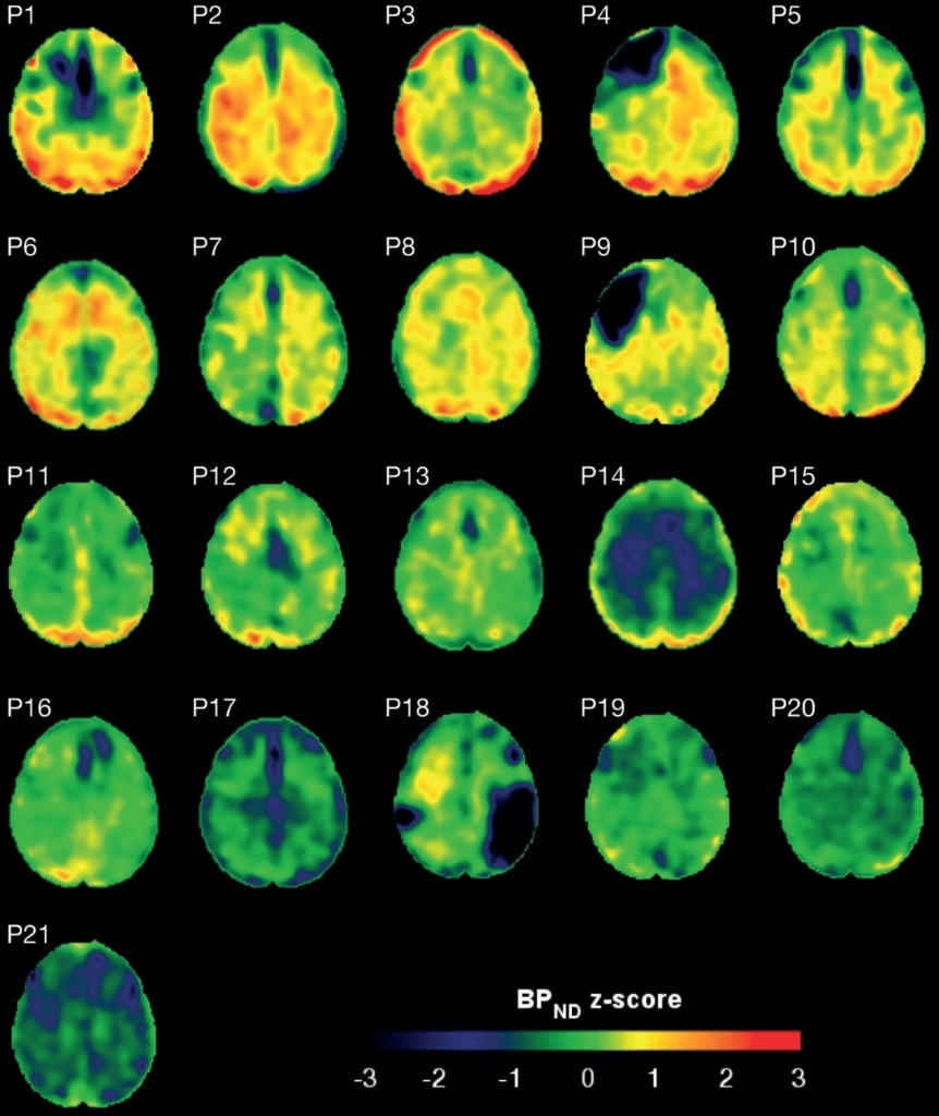 Novel PET method visualizes protein tangles after traumatic brain ...