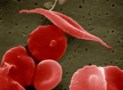 Sickle cell disease