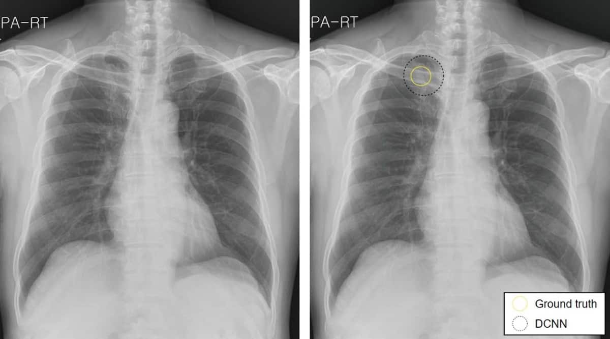 Deep Learning Helps Radiologists Detect Lung Cancer On Chest X rays 