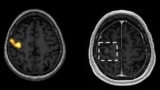 Motor cortex targeting