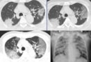 CT scans of coronavirus