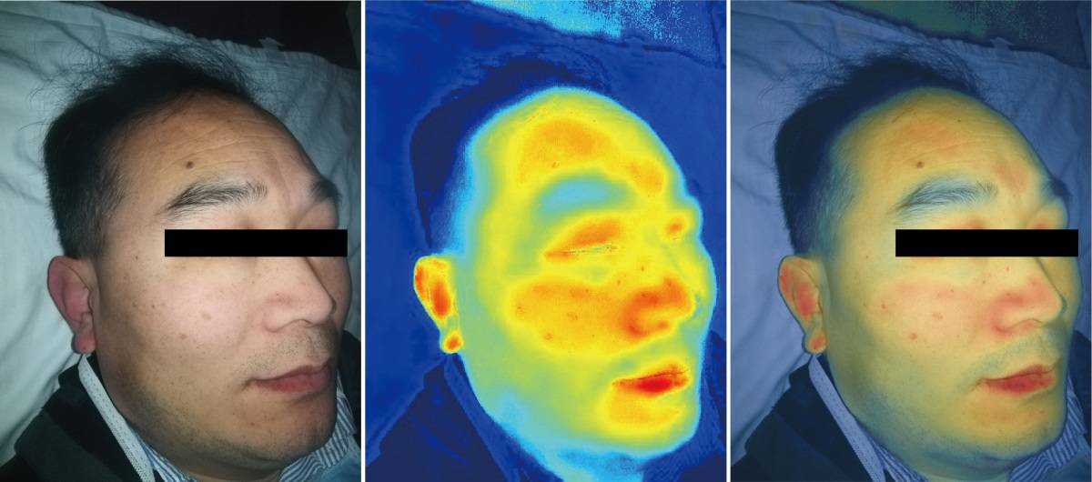 Smartphone Camera Enables Hyperspectral Imaging For Skin Analysis Physics World