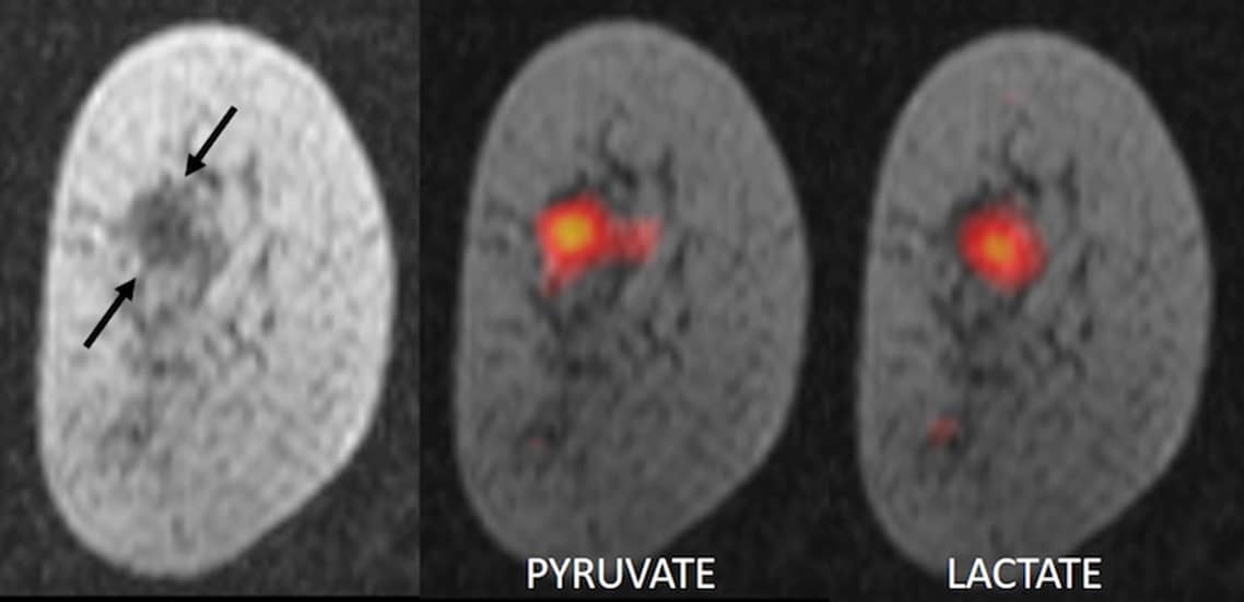 MRI of a breast tumour