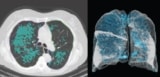 CT scans for emphysema