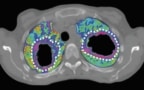 PET/CT scan of an anti-TB drug