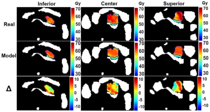 AI Can Enhance MRI-guided Radiation Therapy Plans – Physics World