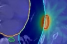 Stereotactic ablative radiotherapy