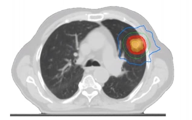 Lung tumour