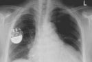 X-ray image showing pacemaker